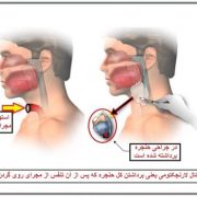 علت تغییر و گرفتگی صدا | درمان التهاب گلو ناشی از اسید معده